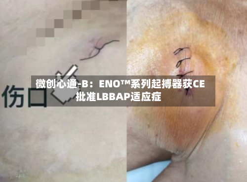 微创心通-B：ENO™系列起搏器获CE批准LBBAP适应症-第2张图片